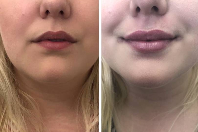 How to Get the Lips You Want: Natural Lip Enhancement