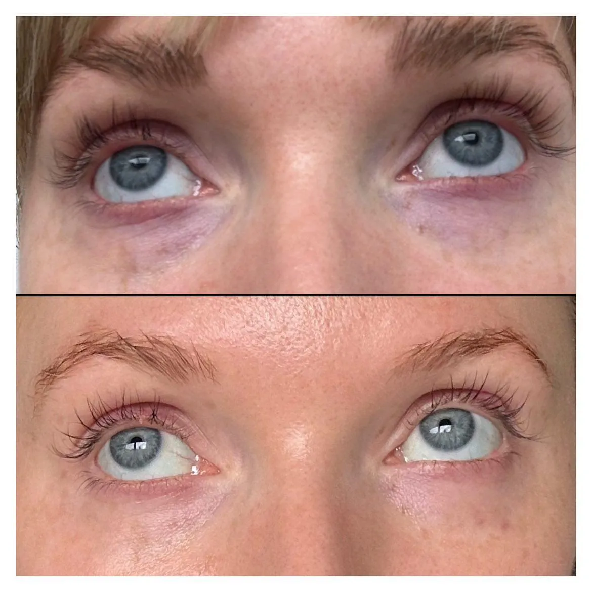 This is a before & after from AM Aesthetics after 1 treatment.